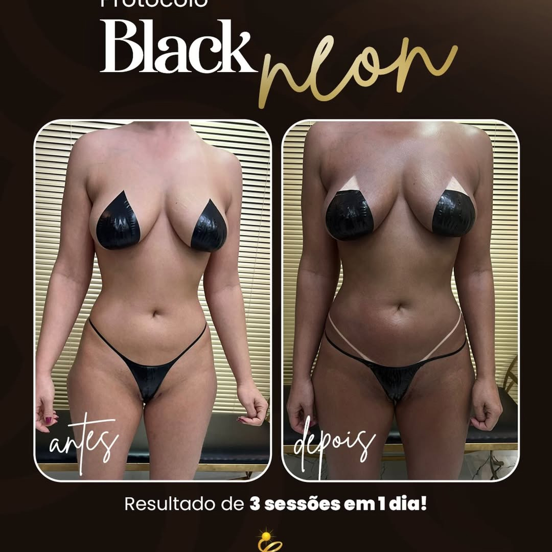 Protocolo Black Neon-O Resultado de Três Sessões de Bronzeamento em Apenas Um Dia